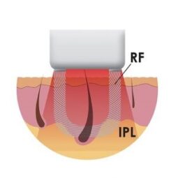 Por qué el sistema E-Light está considerado como la mejor tecnología para obtener una depilación definitiva