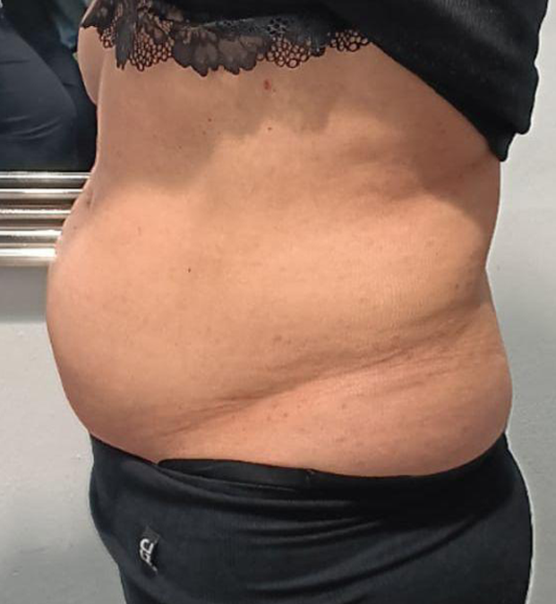 Reafirmación y reducción abdomen vista lateral - ANTES