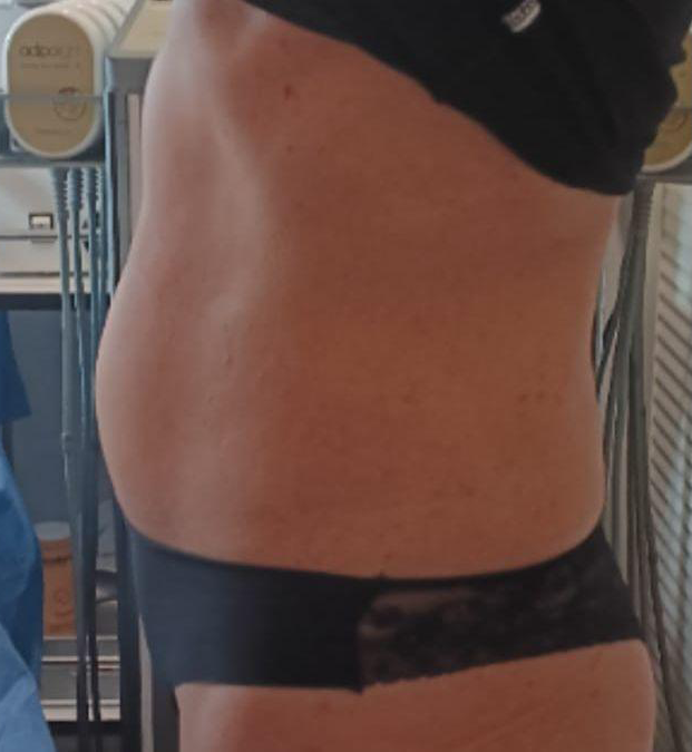 Reafirmación y reducción abdomen vista lateral - DESPUÉS