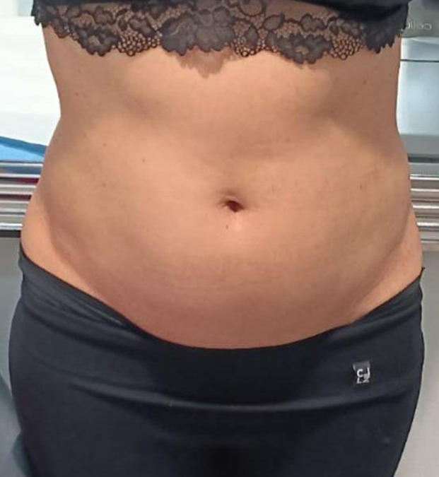 Reafirmación y reducción abdomen vista frontal - ANTES