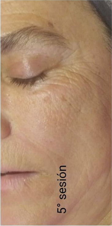 Rejuvenecimiento facial - DESPUÉS