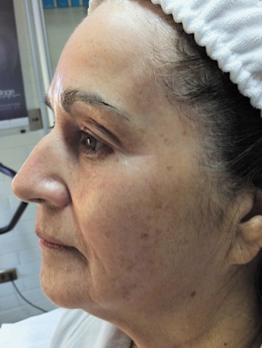 Tratamiento de rejuvenecimiento de Radio Frecuenica + Mesoterapia - DESPUÉS