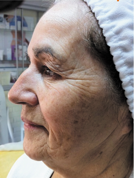 Tratamiento de rejuvenecimiento de Radio Frecuenica + Mesoterapia - ANTES