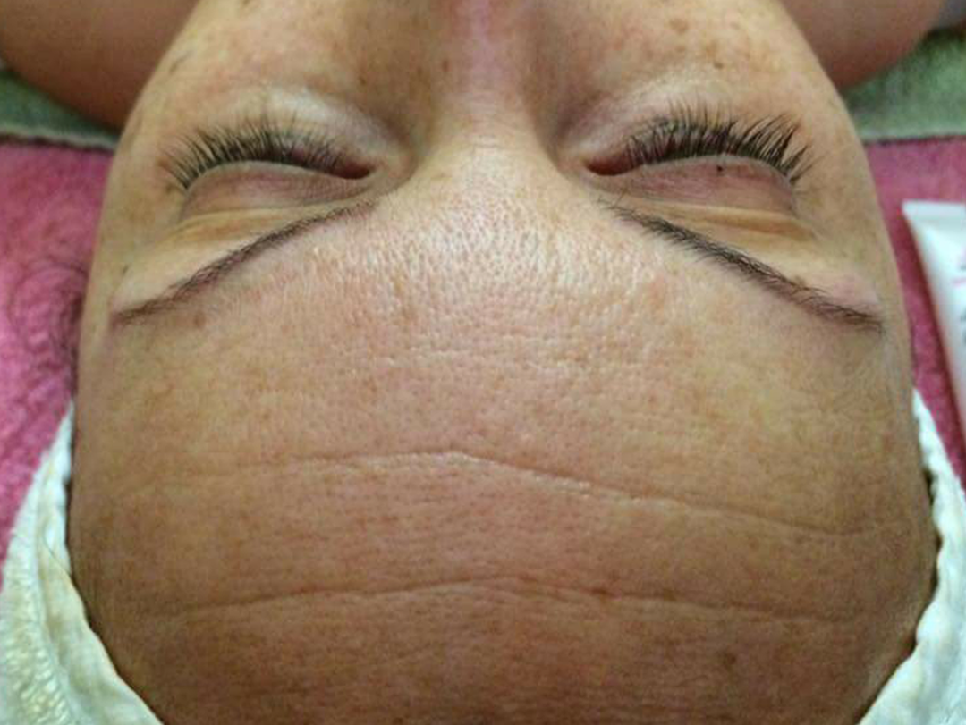 Relleno de arrugas con Mesoterapia Virtual - ANTES