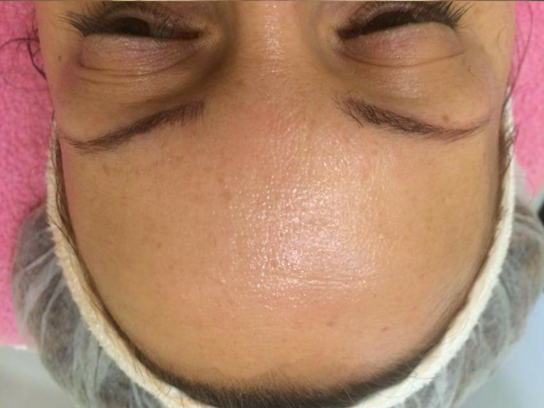 Relleno de arrugas con Mesoterapia Virtual - DESPUÉS