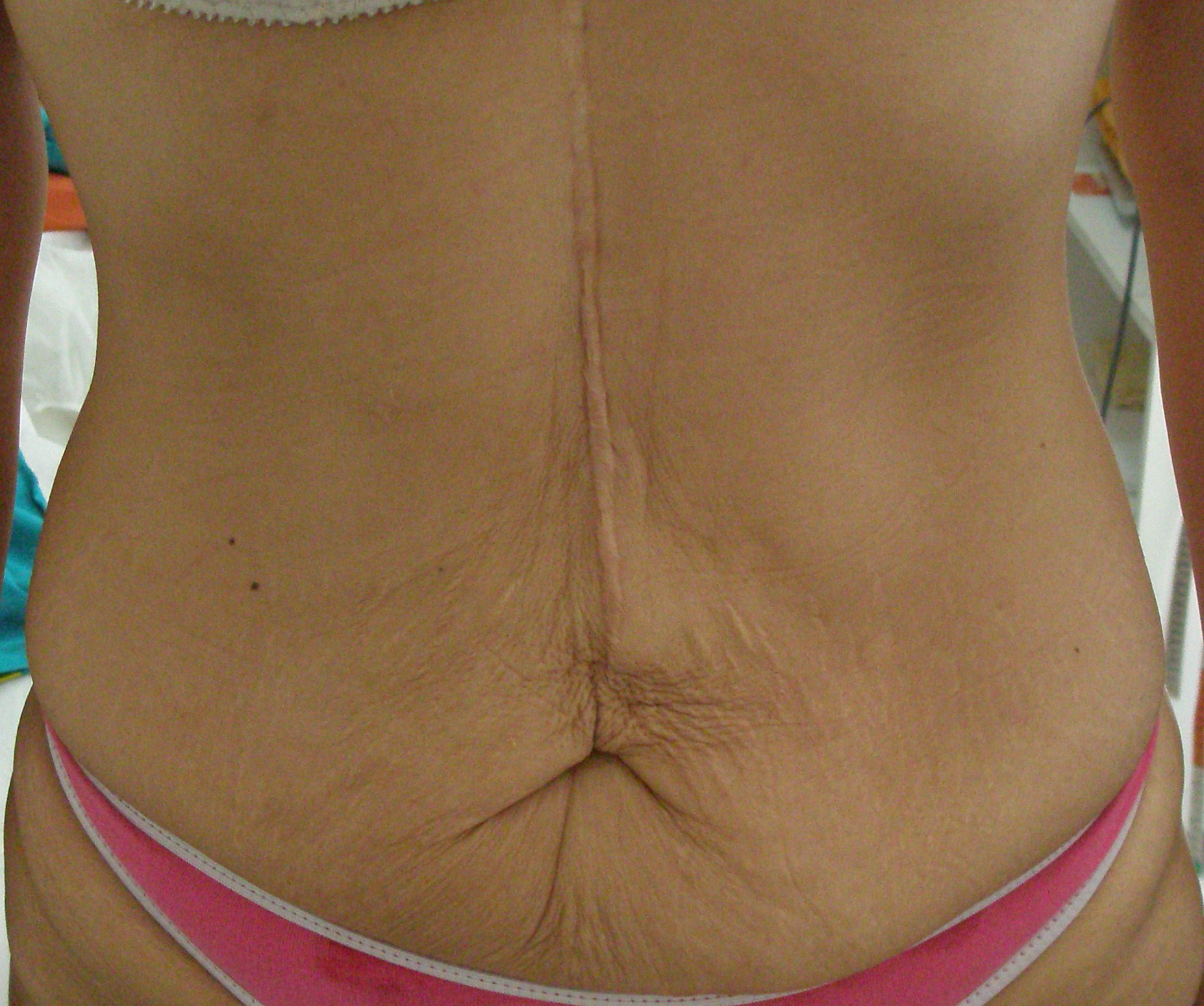 Tratamiento de Reafirmación abdomen - ANTES