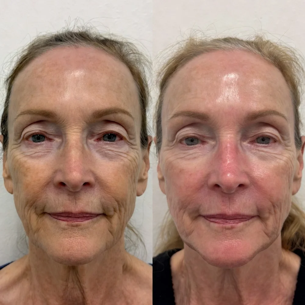 Tratamiento de rejuvenecimiento facial con RF profesional EMOVEX