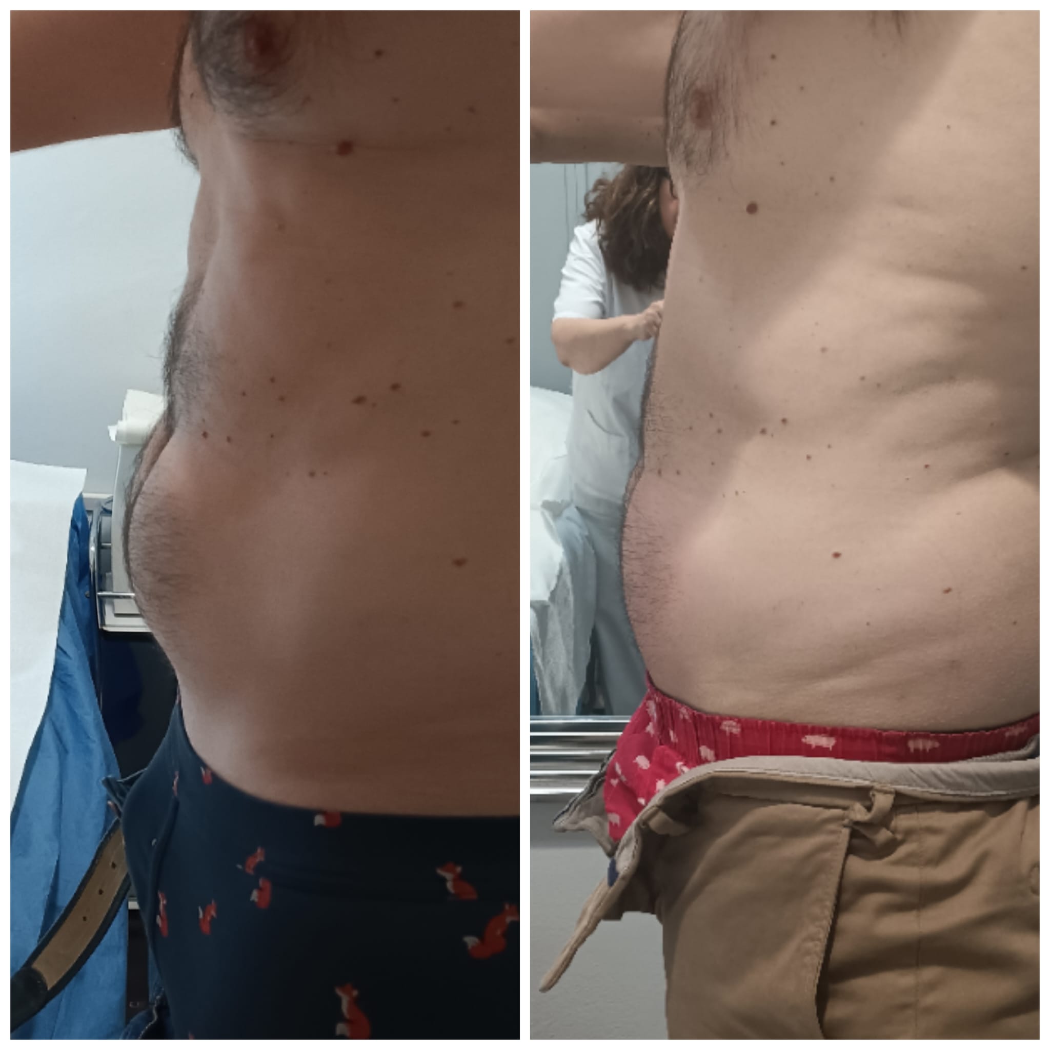Reducción abdomen con radiofrecuencia profesional de EMOVEX