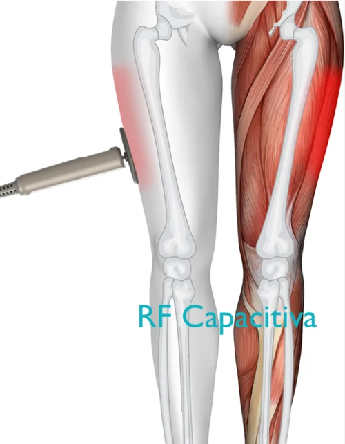 Comportamiento de RF Monopolar Capacitiva en los tejidos