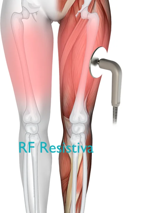 Comportamiento de RF Monopolar Resistiva en los tejidos